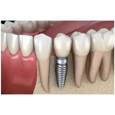 Quin pilar triar per a la restauració d'implants dentals?
