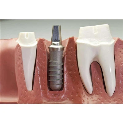 Desbloquejar el misteri: com afecta la interfície de connexió implant-pilar a...