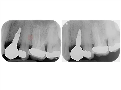 Deu punts clau per al seguiment clínic dels implants dentals