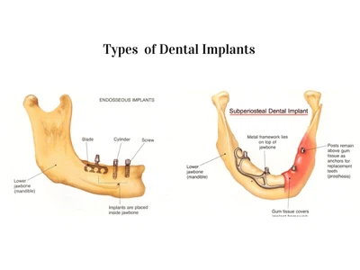 Implantologia dental moderna: classificació dels implants