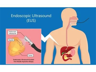 Què és l’ecografia endoscòpica (EUS)?