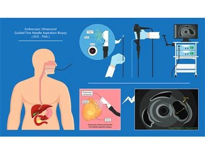Per què necessiteu EUS després d’una gastroscòpia? Respostes d’un gastroenter...