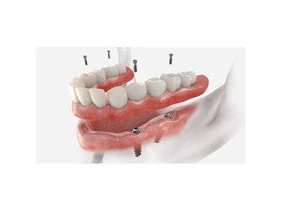 Quins són els tipus d'implants dentals?